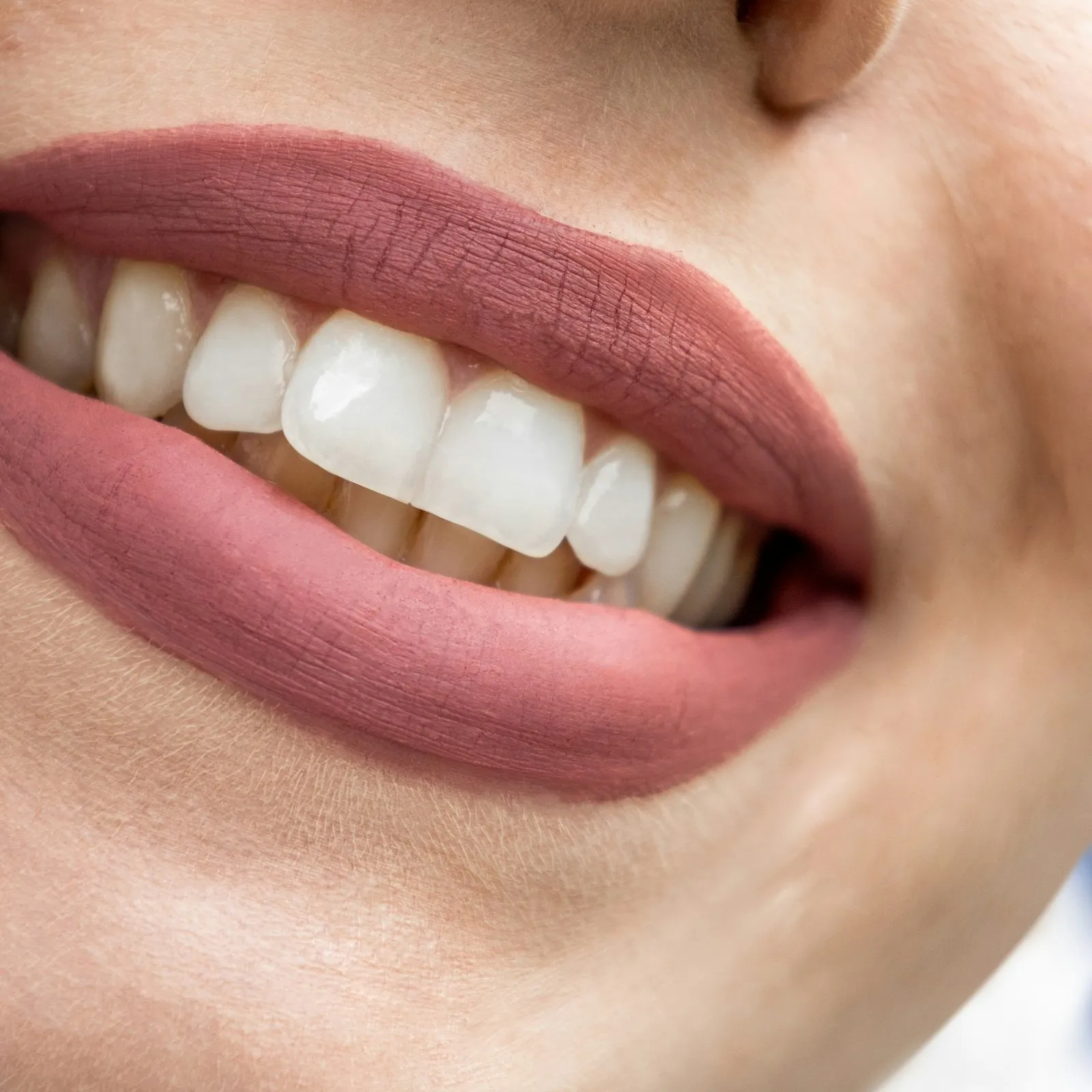 Sorriso dopo lo sbiancamento